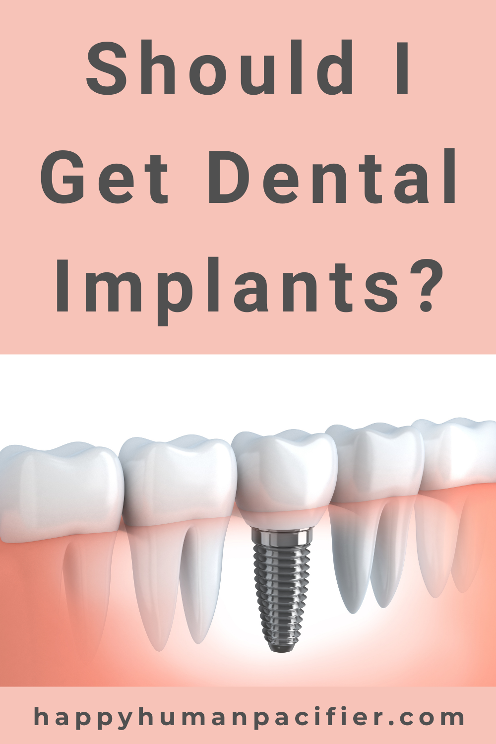 Should I Get Dental Implants? | Why Get Dental Implants