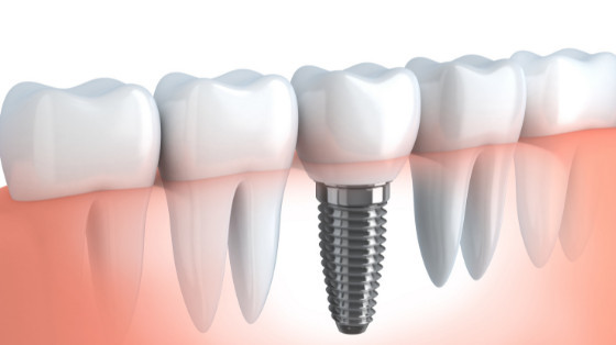 Should I Get Dental Implants?