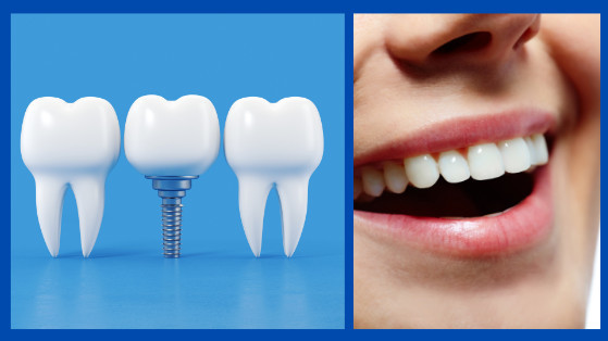 dental implants for tooth loss