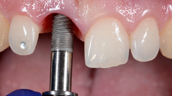 Replacing Patients Missing Teeth With Dental Implants Sydney | 6e33e97e0d21a32b92032200f347cd2f cropped optimized