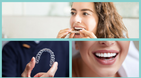 evolution of clear aligners